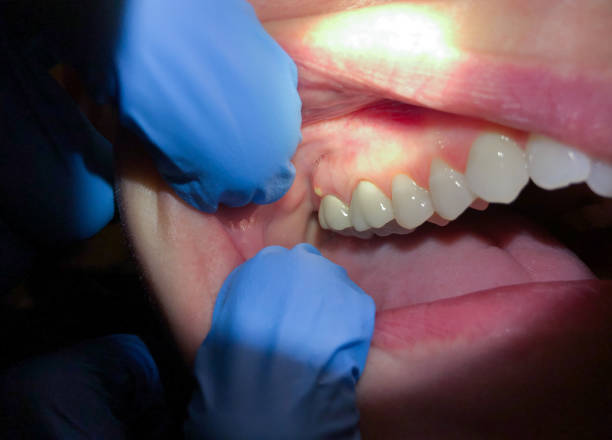 Best Emergency Wisdom Teeth Removal in Lipscom, AL